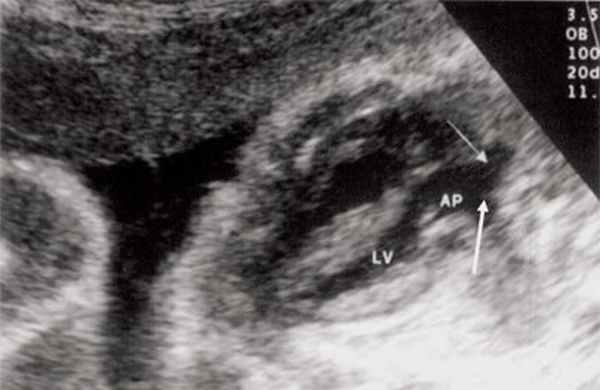 Эхограмма - транспозиция магистральных сосудов, стрелками показаны ветви легочной артерии (АР - легочная артерия, LV - левый желудочек)