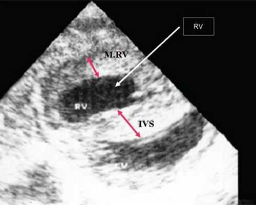 Эхограмма - систолическая перегрузка правого желудочка, поперечное сечение желудочков сердца при стенозе легочной артерии, выраженная гипертрофия межжелудочковой перегородки (IVS) и миокарда передней стенки правого желудочка (MRV), RV - правый желудочек