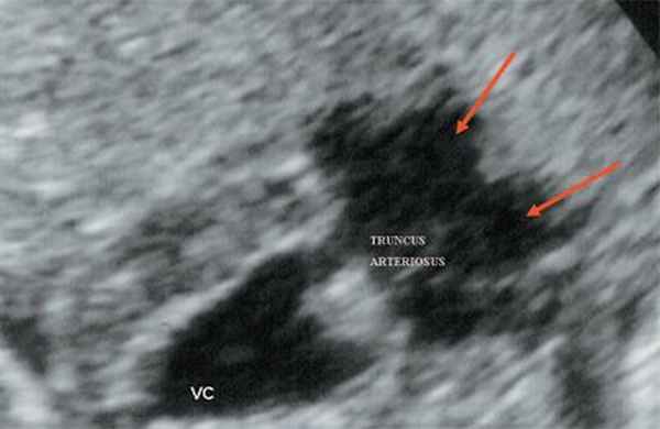 Эхограмма - общий желудочек с отхождением TRUNCUS ARTERIOSUS, стрелками показано разделение TRUNCUS ARTERIOSUS на аорту и ствол легочной артерии (VC - общий желудочек, TRUNCUS ARTERIOSUS - общий артериальный ствол)