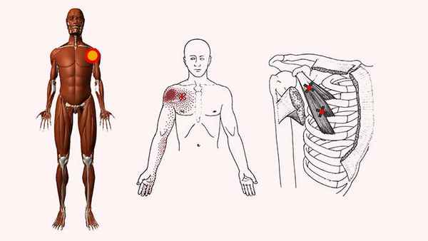 триггерные точки плечевого сустава