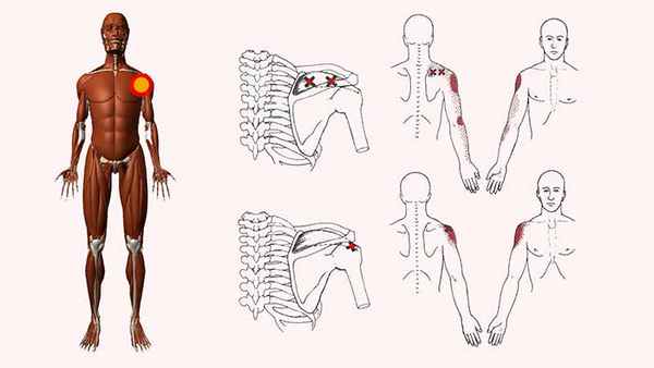 надостная мышца триггерные точки