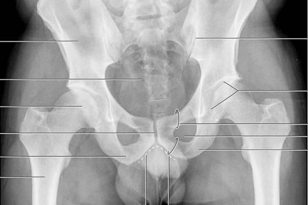 Боль в тазобедренном суставе у мужчин и женщин