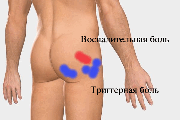 Виды болей в тазобедренном суставе