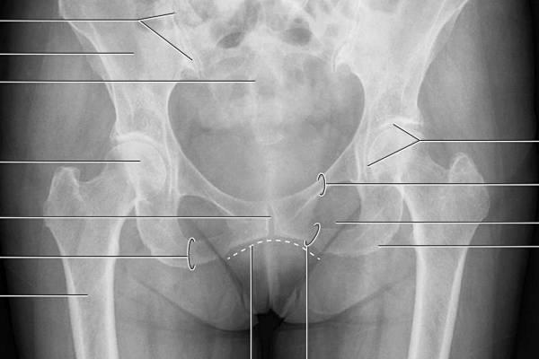 Боли при коксартрозе тазобедренного сустава