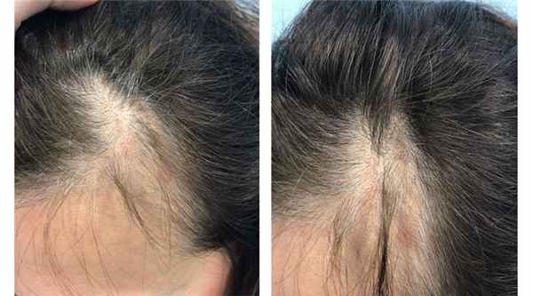 Трихотилломания у женщин