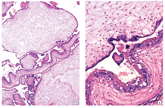 Трофобластическая болезнь
