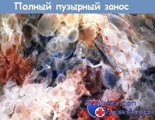 Полный пузырный занос