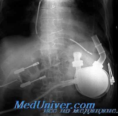тромбоэмболия при вспомогательном кровообращении