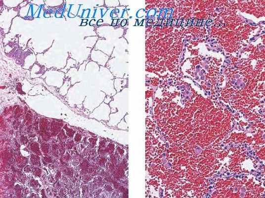 морфология тромбоэмболии