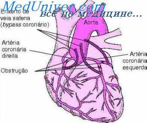 нестабильная стенокардия