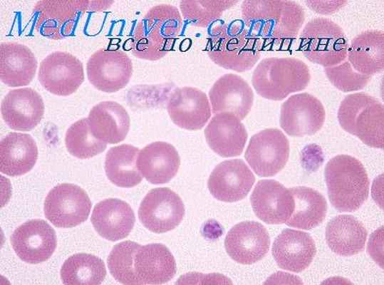 тромбоцитопатии новорожденных