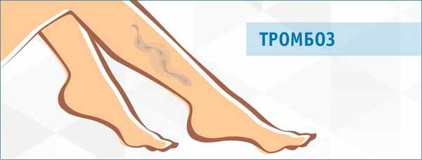 Тромбоз глубоких вен