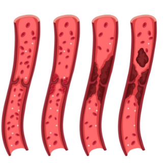 Тромбоз вен