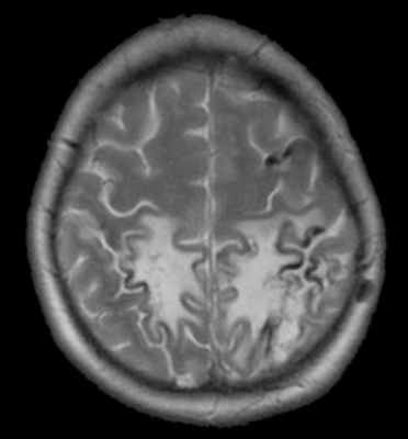 венозный инфоркт на МРТ-обр