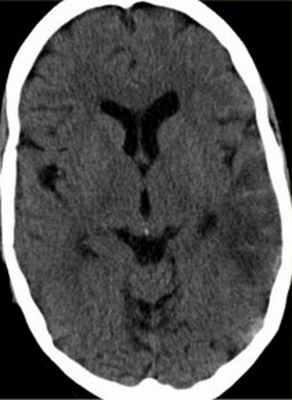 венозный инфаркт-неконтр