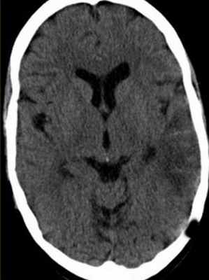 тромбоз вены Лаббе-обр-2