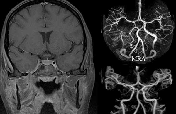 тромбоз кавернозного синуса