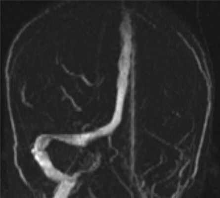 tromboz-levogo-poperechnogo-sinusa-na-mrv