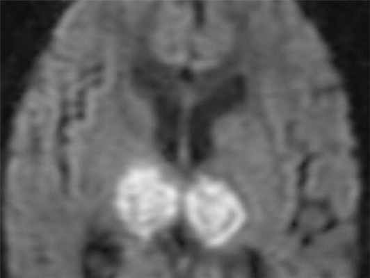 venoznye-infarkty-dvi