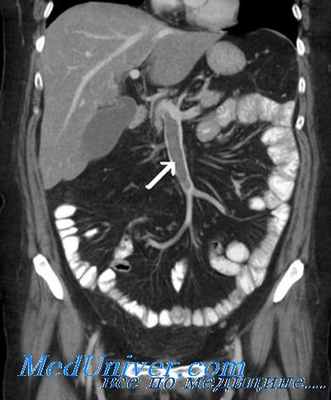 Ангиография при мезентриальном тромбозе
