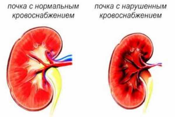 тромбоз почечных артерий