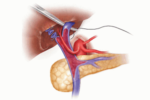 Тромбоз воротной вены