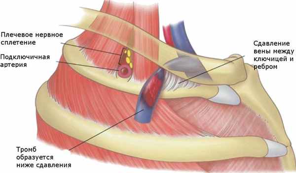 Механизм развития тромбоза подключичной вены
