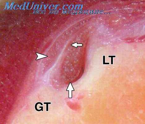 трупные пятна