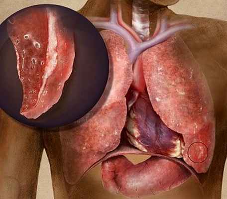 Фото Туберкулез бронхов