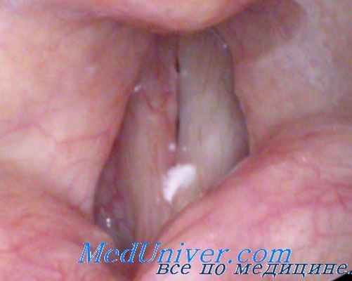 туберкулез гортани