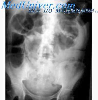 туберкулез кишечника