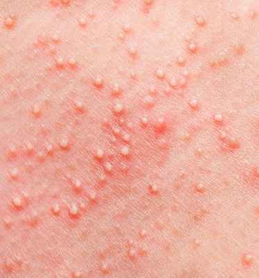 Фото Туберкулез кожи