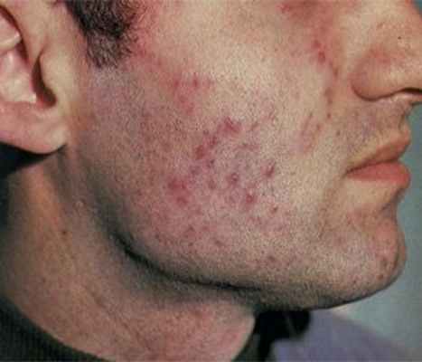 Туберкулез кожи