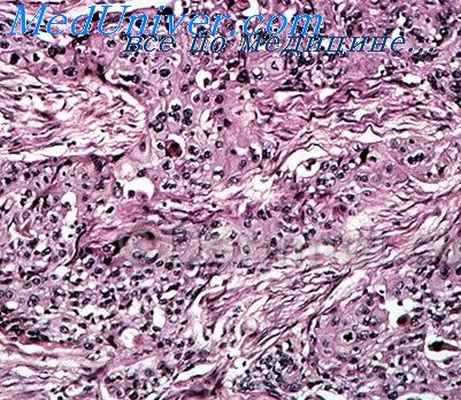 туберкулез кожи