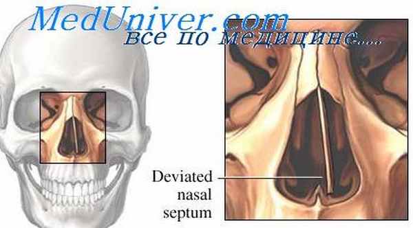 туберкулез носа