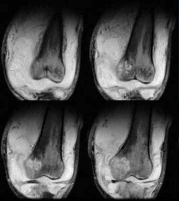 Туберкулез костей