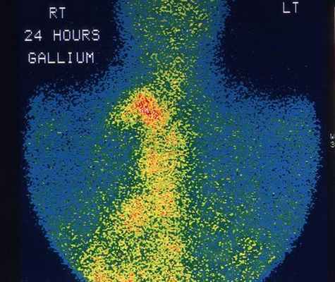 Неходжкинские лимфомы (лимфосаркома)