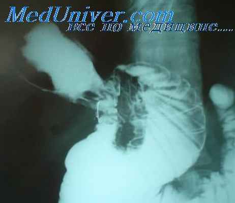 язвы желудка