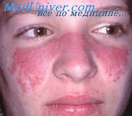 подкожный саркоидоз