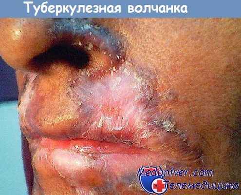 туберкулезная волчанка
