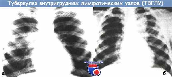 Туберкулез внутригрудных лимфатических узлов