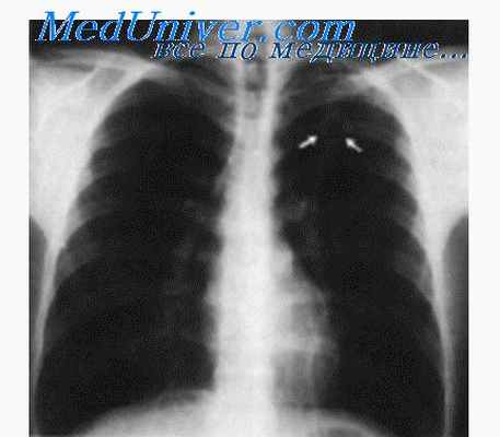 туберкулез легких