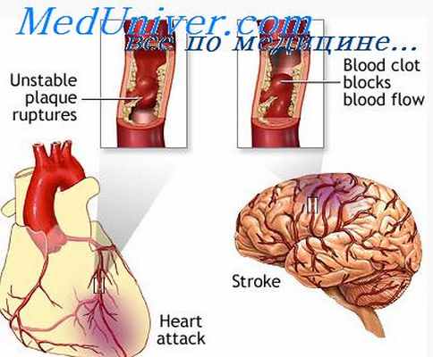 туберкулезный менингит