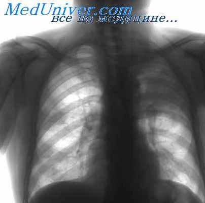 туберкулезный менингит