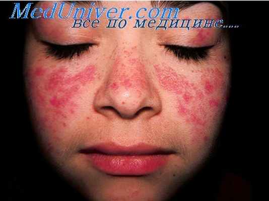 туберкулез кожи