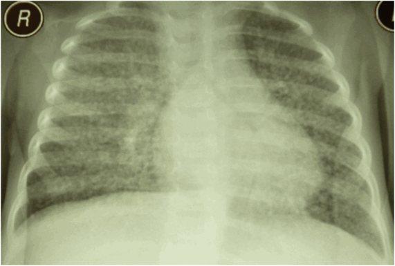 U. Обзорная рентгенограмма органов грудной клетки с милиарным туберкулезом легких у ребенка одного года и б месяцев