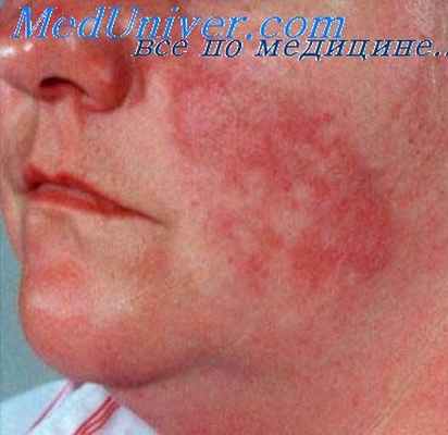 туберкулез кожи