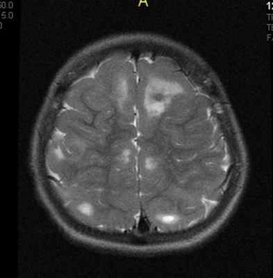 туберозный склероз2