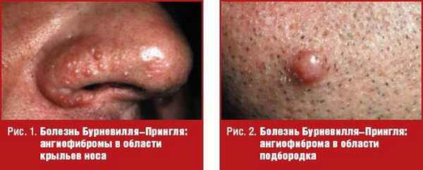 Болезнь Бурневилля–Прингля