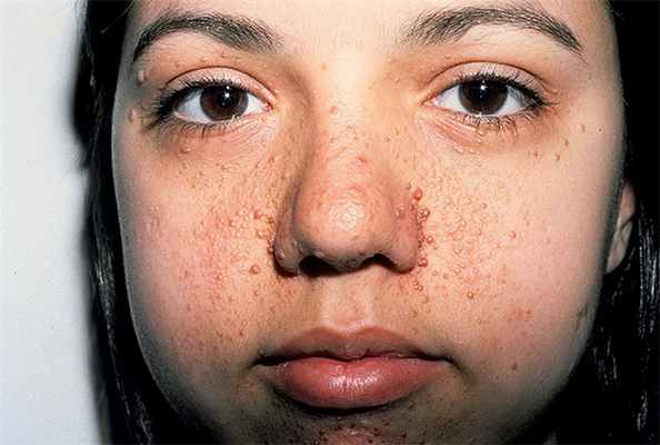 туберозный склероз